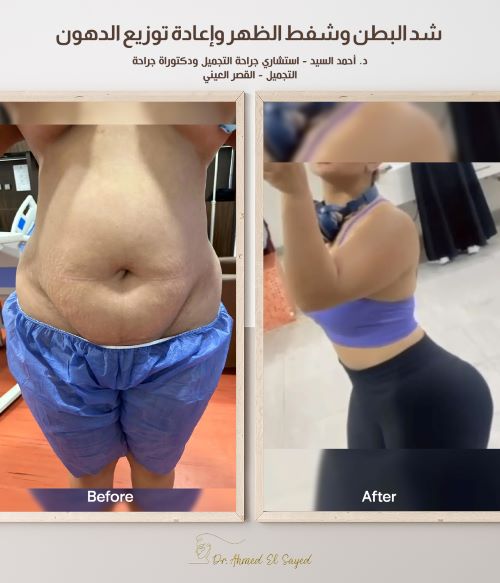 افضل دكتور لشد ترهلات البطن في مصر
